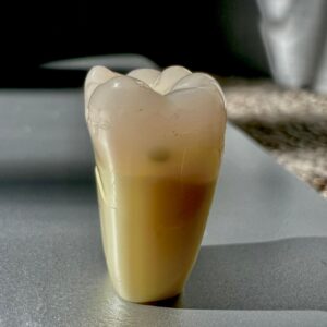 Carious teeth